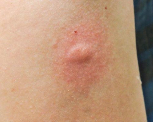 picadura_de_mosquito